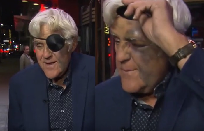 Jay Leno badly injured from falling down 60-foot hill