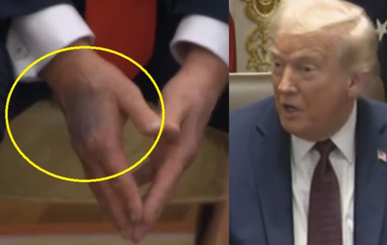 Trump’s hand makeup returns, sparking speculations